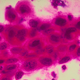 Cancer cells in the cervix